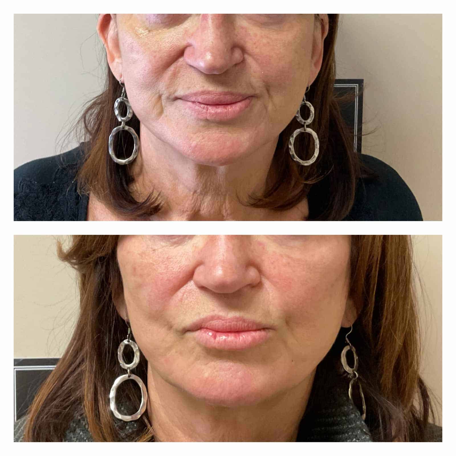 60 Year Old Patient Before After Chin Forward