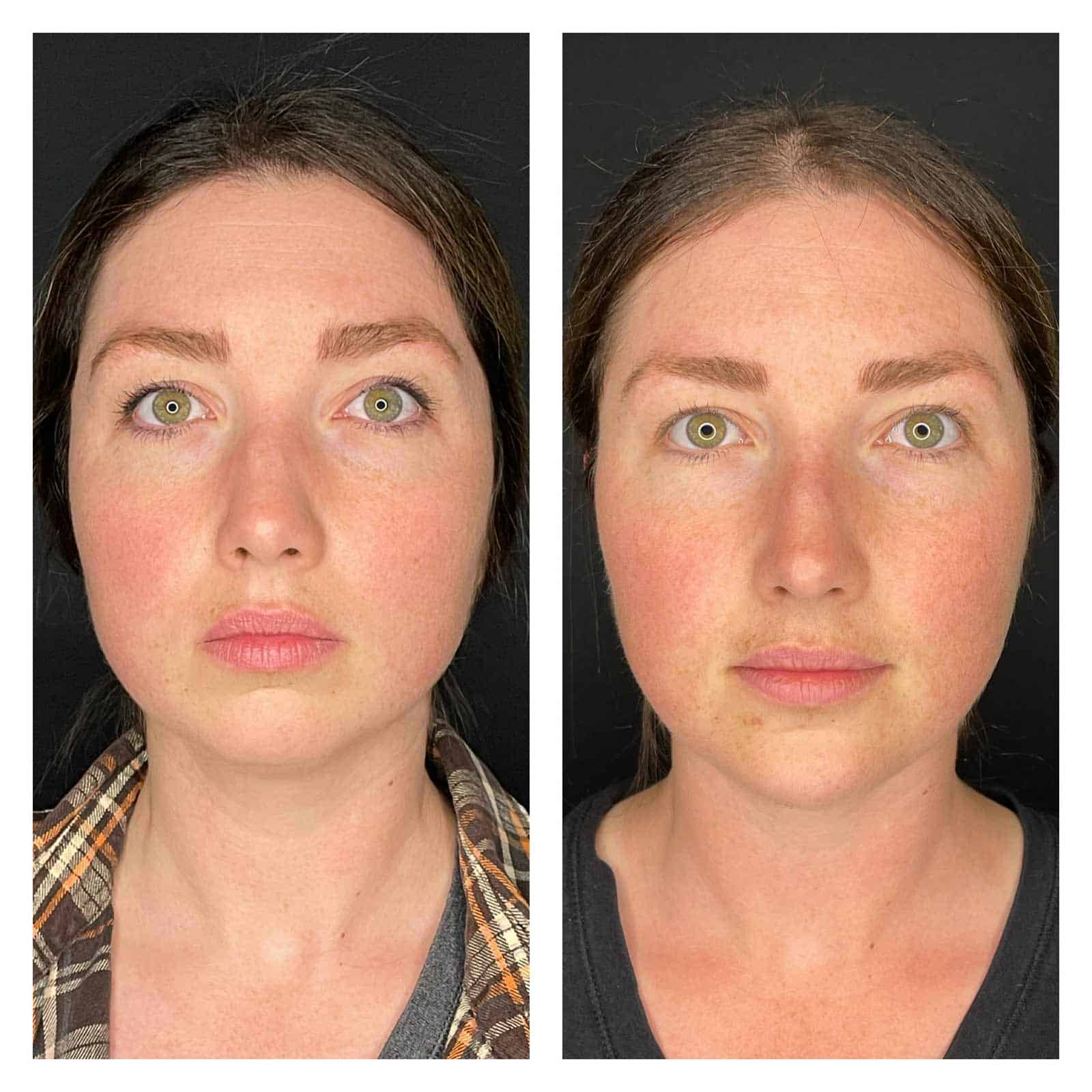 30 Year Old Patient Before After Face Forward