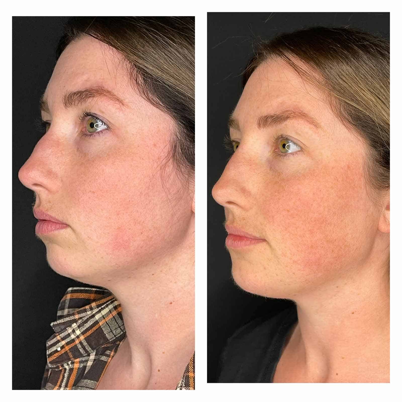 30 Year Old Patient Before After Face Side Left