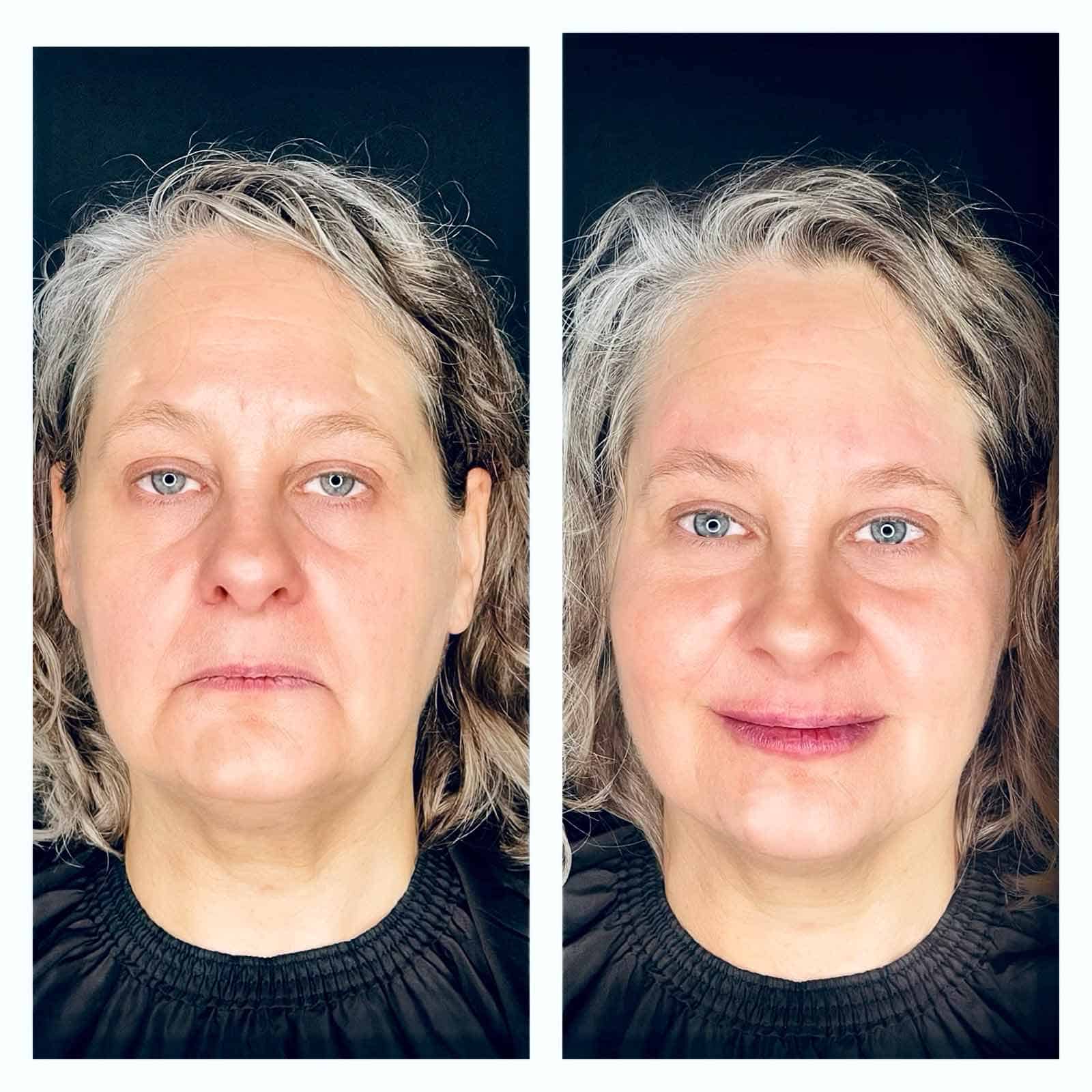 52 Year Old Patient Before After Face Front