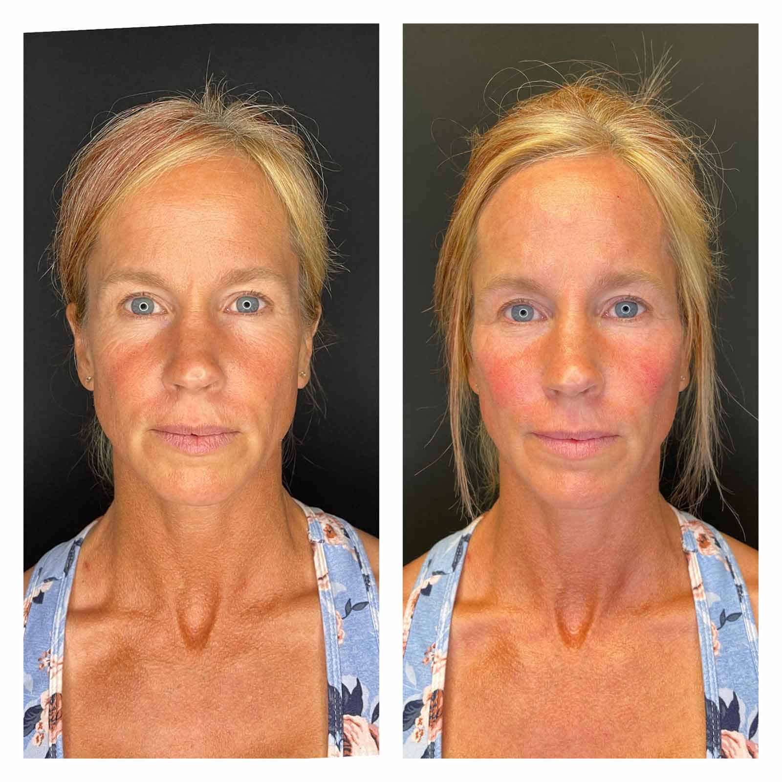 46 Year Old Patient Before After Face Front