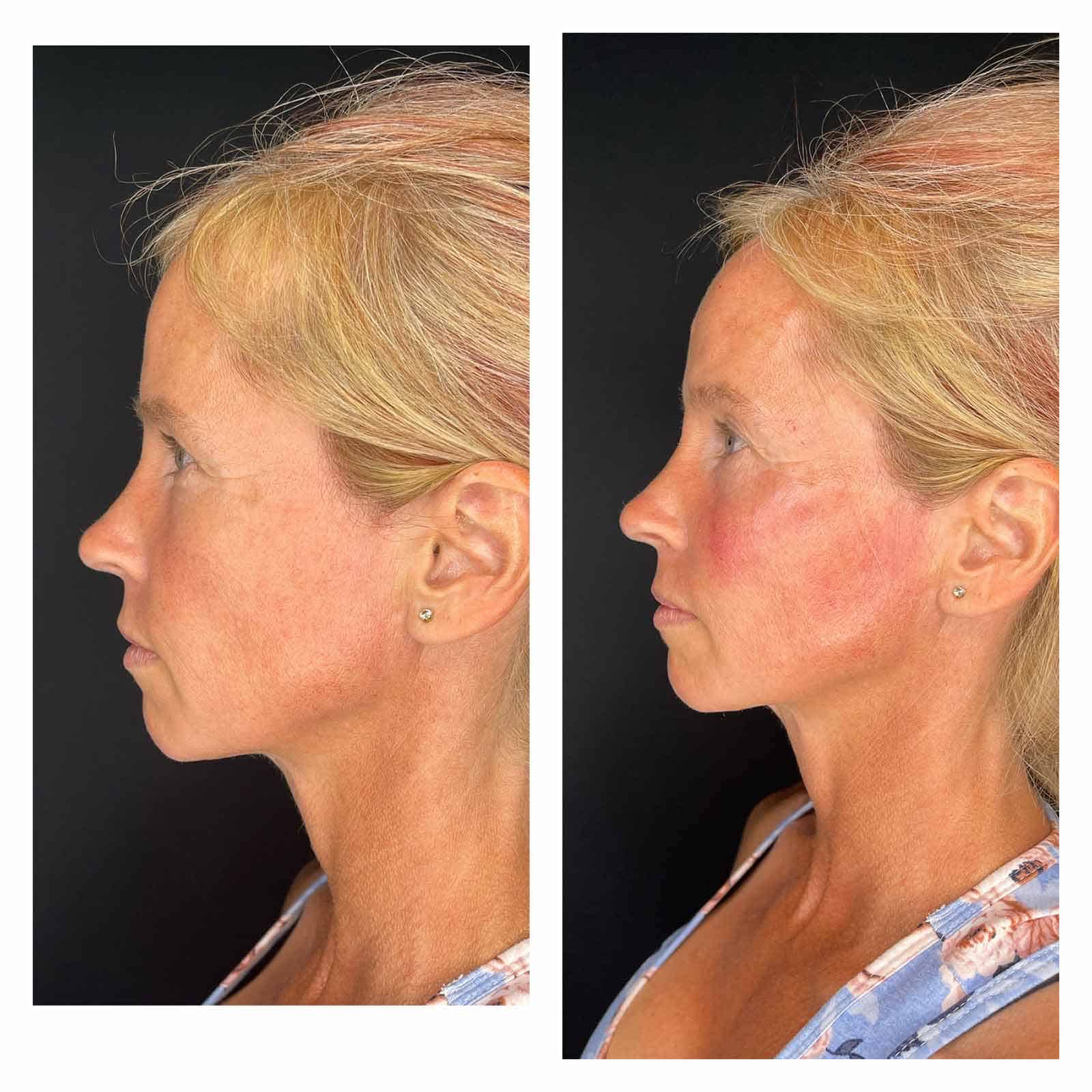 46 Year Old Patient Before After Face Side