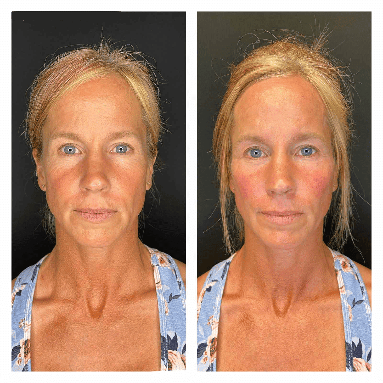 Tammy Before After Face Forward