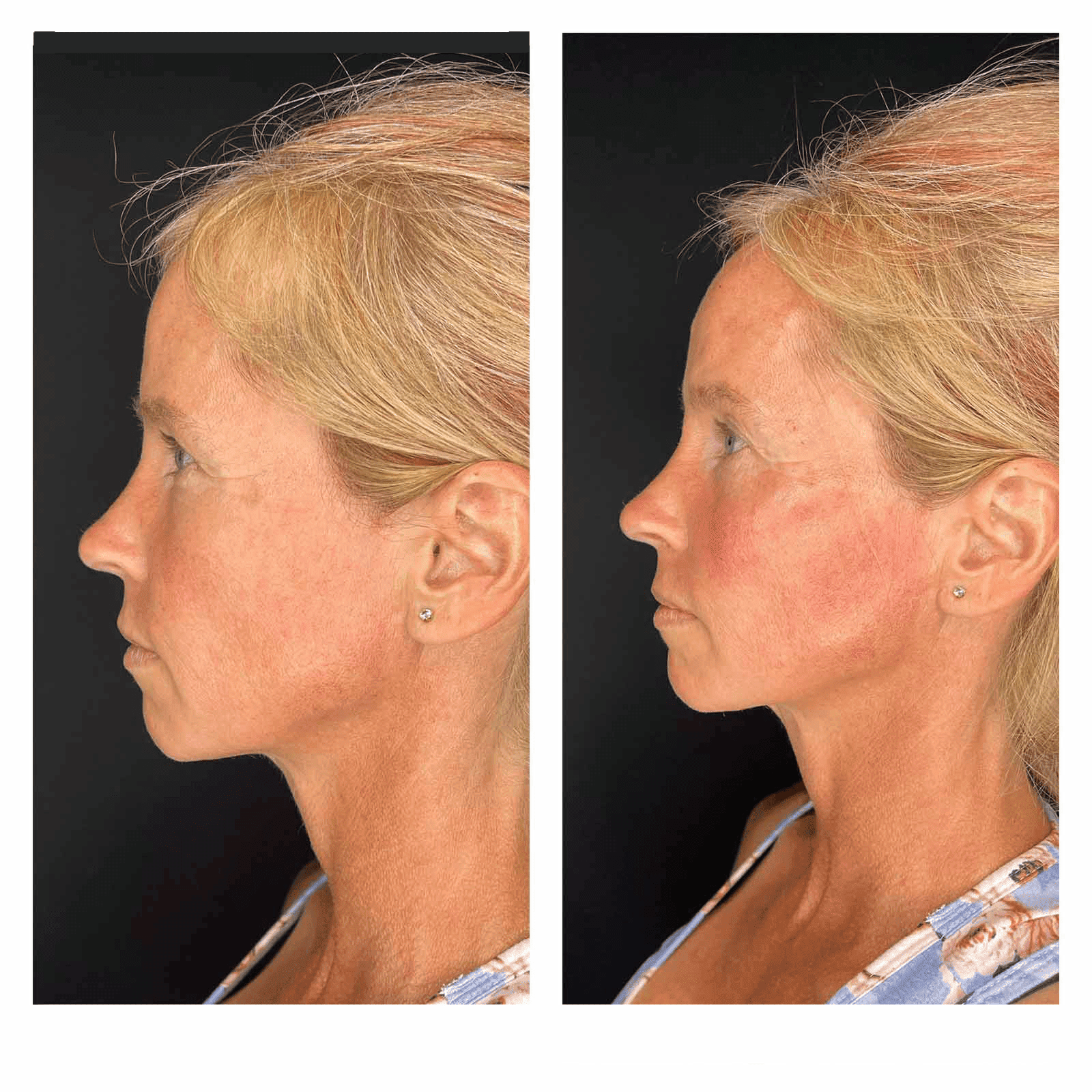 Tammy Before After Face Side
