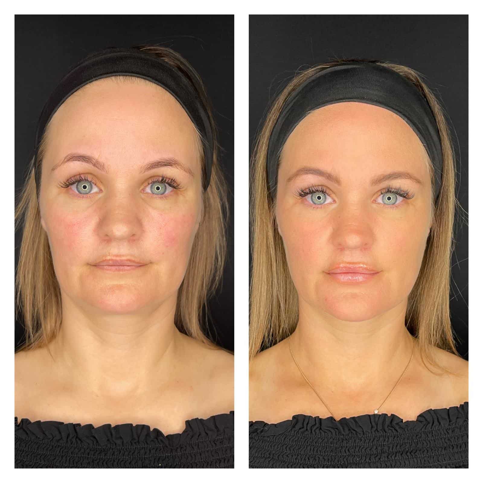 Bw-Before-And-After-1