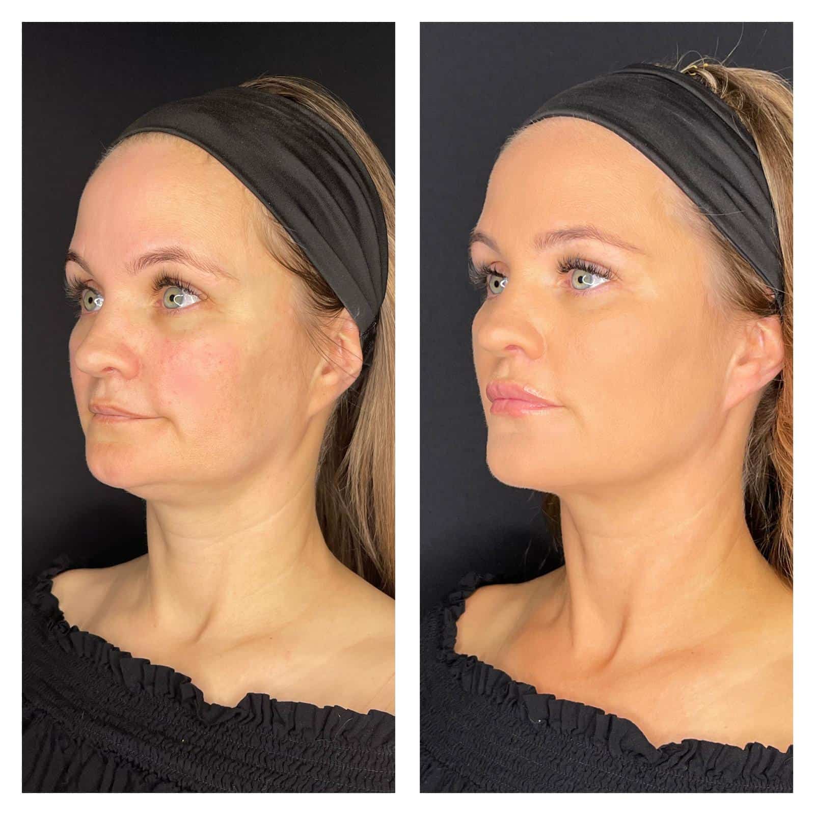 Bw-Before-And-After-3