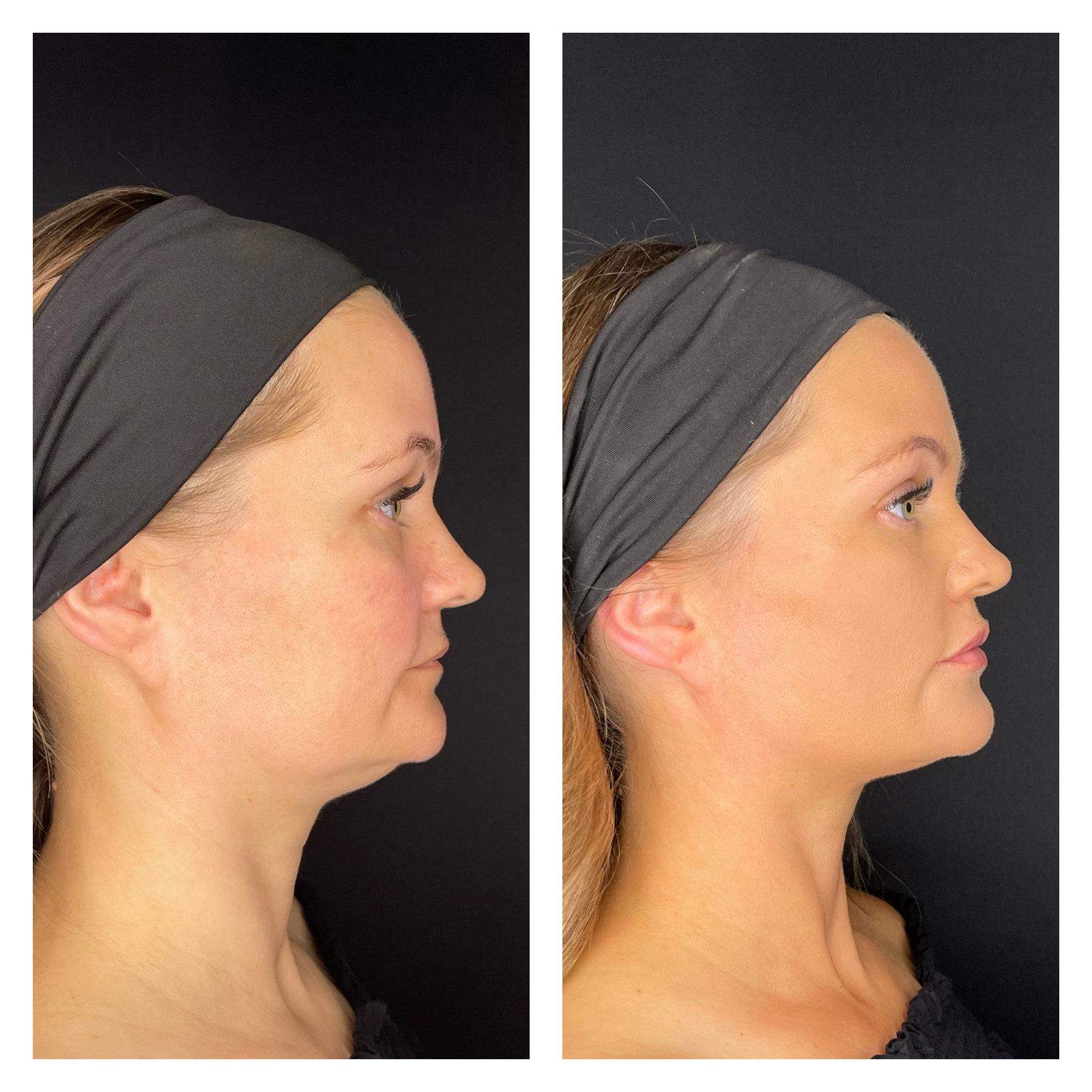 Bw-Before-And-After-4
